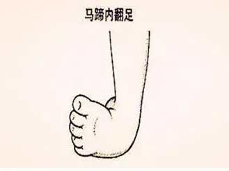 一旦發現孩子“腳彎彎”? 需要您 “足”夠重視