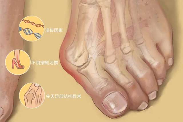常穿高跟鞋、尖頭鞋女性謹(jǐn)防拇外翻的發(fā)生！