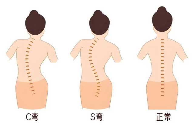 莫讓脊柱側彎毀掉孩子一生幸福！專利技術讓孩子挺直脊梁！暑期矯正預約開始了！